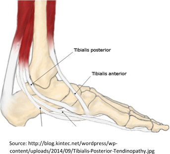 Tibialis Posterior Tendinopathy - Fix Podiatry