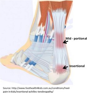 Achilles Tendinopathy