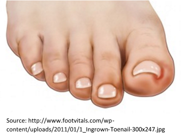 Ingrown Toenails - Fix Podiatry