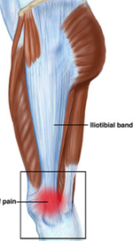 Iliotibial Band Friction (ITB) Syndrome, SportsIn Orthopaedic Clinic