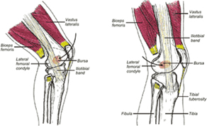 ITB Friction syndrome - Fix Podiatry