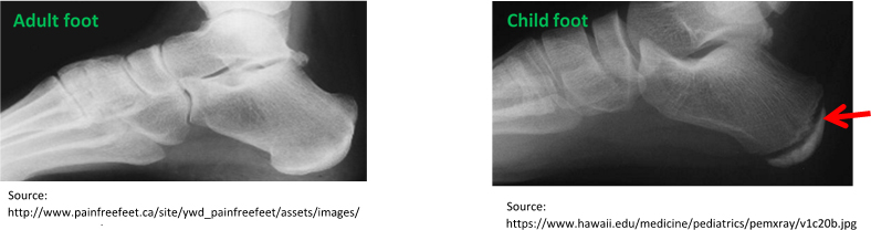 Medial Epicondylar Fractures - Pediatric - Pediatrics - Orthobullets