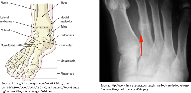 Fig. 8.5, [Calcaneal stress fracture. Sagittal fat-suppressed...]. -  Musculoskeletal Diseases 2021-2024 - NCBI Bookshelf